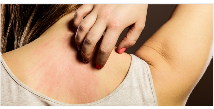 can glutathione cause hives Understanding Hives in Children main image 0